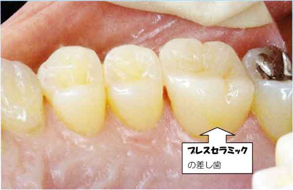 Pressceramic001